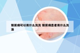 银屑病可以用什么洗洗 银屑病患者用什么洗澡