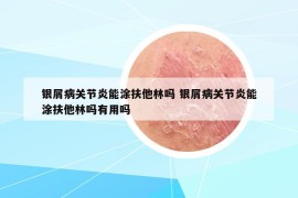 银屑病关节炎能涂扶他林吗 银屑病关节炎能涂扶他林吗有用吗