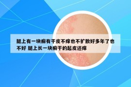 腿上有一块癣有干皮不痒也不扩散好多年了也不好 腿上长一块癣干的起皮还痒