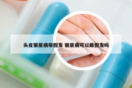 头皮银屑病带假发 银屑病可以戴假发吗