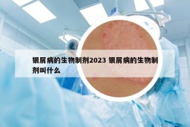 银屑病的生物制剂2023 银屑病的生物制剂叫什么