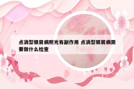 点滴型银屑病照光有副作用 点滴型银屑病需要做什么检查