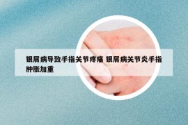 银屑病导致手指关节疼痛 银屑病关节炎手指肿胀加重