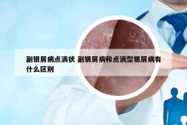 副银屑病点滴状 副银屑病和点滴型银屑病有什么区别