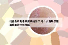 吃什么有助于银屑病的治疗 吃什么有助于银屑病的治疗和预防