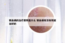 银血病的治疗原则是什么 银血病有没有彻底治好的