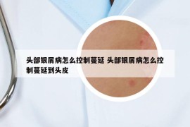 头部银屑病怎么控制蔓延 头部银屑病怎么控制蔓延到头皮