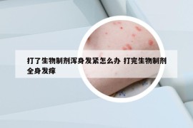 打了生物制剂浑身发紧怎么办 打完生物制剂全身发痒