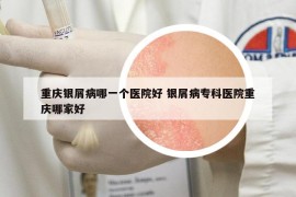 重庆银屑病哪一个医院好 银屑病专科医院重庆哪家好