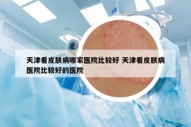 天津看皮肤病哪家医院比较好 天津看皮肤病医院比较好的医院