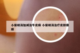 小柴胡汤加减治牛皮癣 小柴胡汤治疗皮肤瘙痒