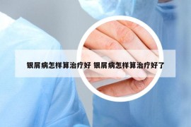 银屑病怎样算治疗好 银屑病怎样算治疗好了