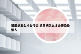 银屑病怎么才会传染 银屑病怎么才会传染给别人