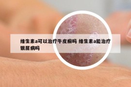 维生素a可以治疗牛皮癣吗 维生素a能治疗银屑病吗