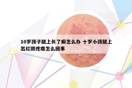 10岁孩子腿上长了癣怎么办 十岁小孩腿上出红斑疙瘩怎么回事