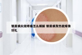 银屑病火烧疼痛怎么缓解 银屑病发热就痒像针扎