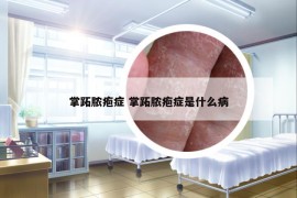 掌跖脓疱症 掌跖脓疱症是什么病