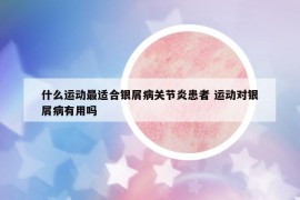 什么运动最适合银屑病关节炎患者 运动对银屑病有用吗