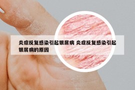 炎症反复感染引起银屑病 炎症反复感染引起银屑病的原因