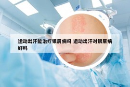 运动出汗能治疗银屑病吗 运动出汗对银屑病好吗