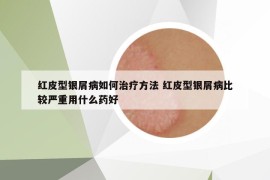 红皮型银屑病如何治疗方法 红皮型银屑病比较严重用什么药好