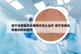 南宁皮肤医院白癜风印怎么治疗 南宁皮肤白斑看的好的医院