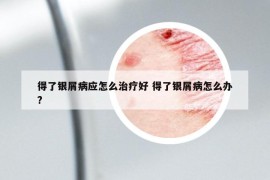 得了银屑病应怎么治疗好 得了银屑病怎么办?