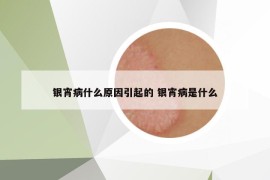 银宵病什么原因引起的 银宵病是什么