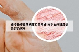 南宁治疗银屑病那家医院好 南宁治疗银屑病最好的医院