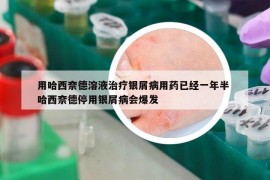 用哈西奈德溶液治疗银屑病用药已经一年半 哈西奈德停用银屑病会爆发