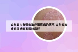 山东省内有哪些治疗银屑病的医院 山东省治疗银屑病哪家医院最好