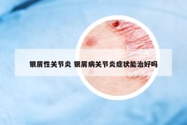 银屑性关节炎 银屑病关节炎症状能治好吗