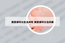 银屑病可以去当兵吗 银屑病可以当兵嘛