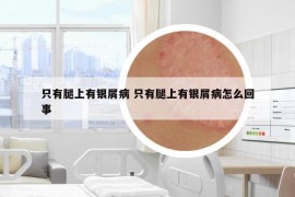 只有腿上有银屑病 只有腿上有银屑病怎么回事