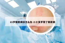 21岁银屑病该怎么办 二十多岁得了银屑病