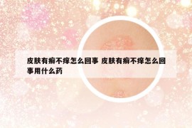 皮肤有癣不痒怎么回事 皮肤有癣不痒怎么回事用什么药