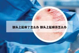 额头上起癣了怎么办 额头上起癣该怎么办