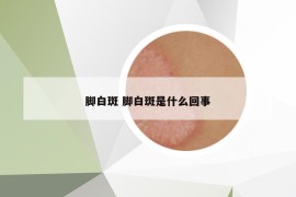 脚白斑 脚白斑是什么回事