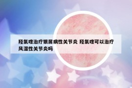 羟氯喹治疗银屑病性关节炎 羟氯喹可以治疗风湿性关节炎吗