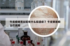 牛皮癣银宵以后有什么后遗症了 牛皮银屑癣治疗周期