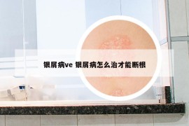 银屑病ve 银屑病怎么治才能断根