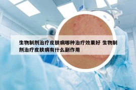 生物制剂治疗皮肤病哪种治疗效果好 生物制剂治疗皮肤病有什么副作用