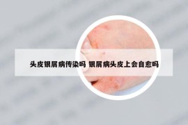 头皮银屑病传染吗 银屑病头皮上会自愈吗