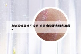 点滴形银屑病不戒烟 银屑病需要戒烟戒酒吗?