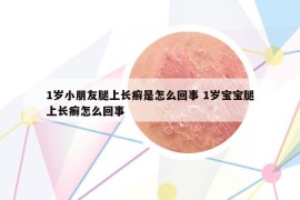 1岁小朋友腿上长癣是怎么回事 1岁宝宝腿上长癣怎么回事