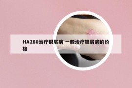 HA280治疗银屑病 一般治疗银屑病的价格