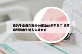 我的牛皮癣在海南66度治的差不多了 银屑病到海南生活多久就会好