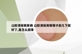 口腔溃疡银屑病 口腔溃疡用银镯子刮几下就好了,是怎么回事