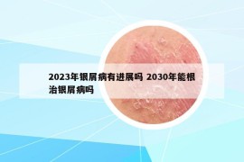 2023年银屑病有进展吗 2030年能根治银屑病吗