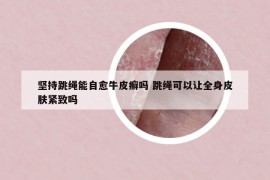 坚持跳绳能自愈牛皮癣吗 跳绳可以让全身皮肤紧致吗